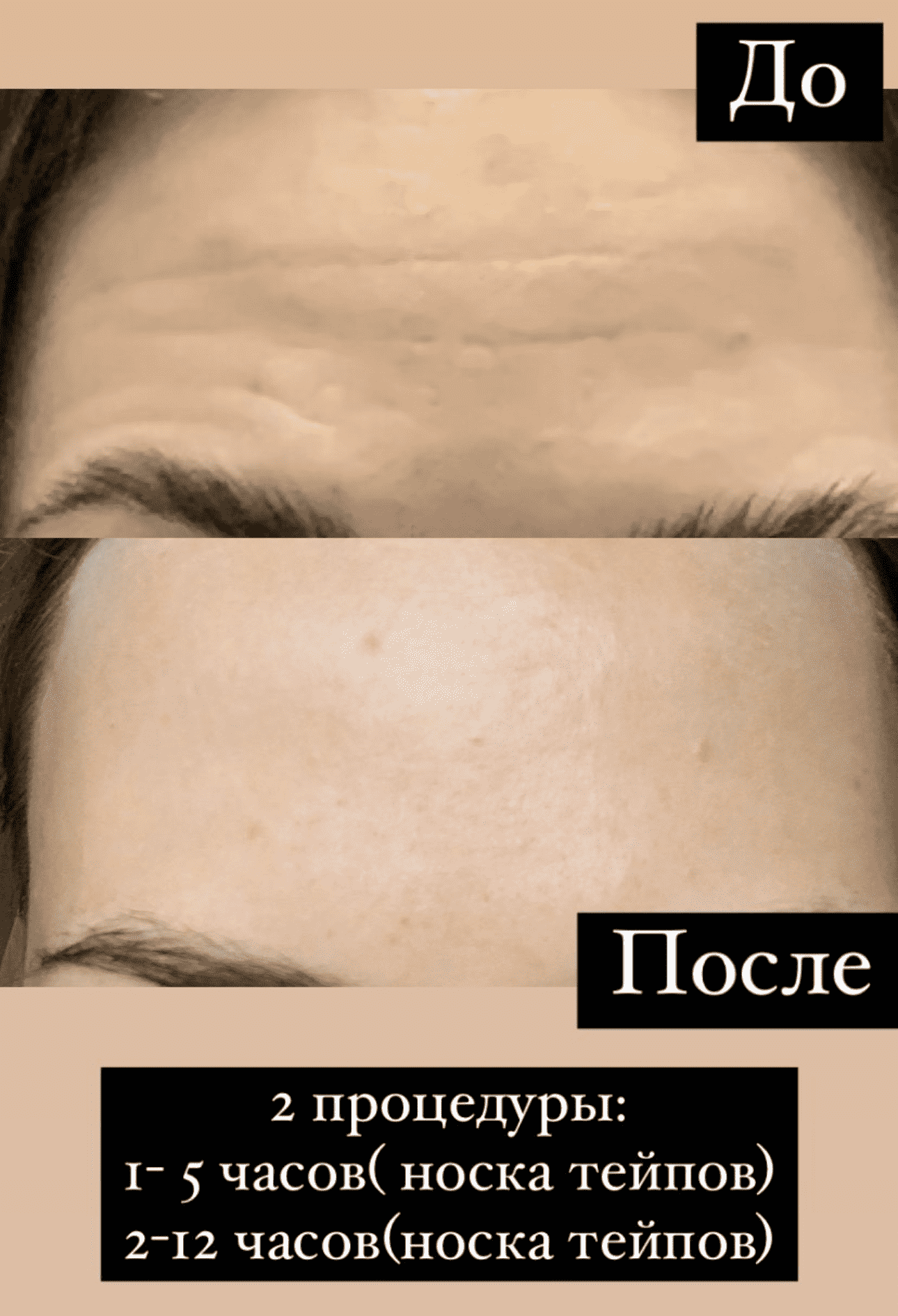 Омоложение лица в Минске со скидкой, лазерное омоложение по выгодным ценам  – действенные процедуры